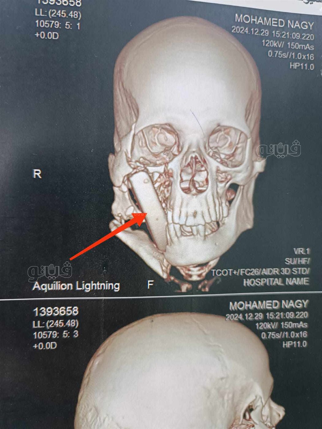 فريق طبي بجامعة أسيوط ينجح في استخراج حجر صخري من وجه مريض،فيتو1