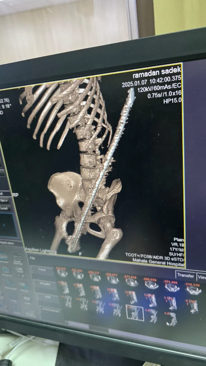 فريق طبي بمستشفى المحلة العام ينجح في استخراج سيخ حديدي اخترق جسم عامل بناء
