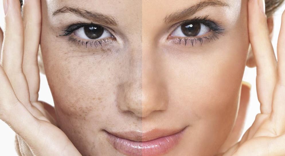 تصبغات البشرة