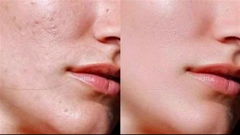 قناع طبيعي يخلصك من الكلف بالوجه&nbsp;