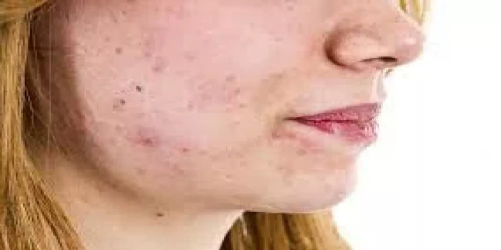 أعراض ارتفاع هرمون الذكورة عند النساء&nbsp;
