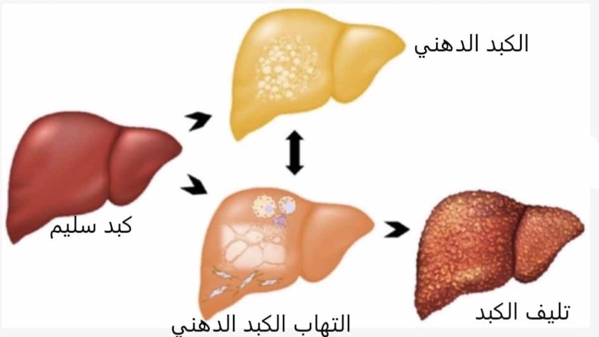 &nbsp;الكبد الدهني