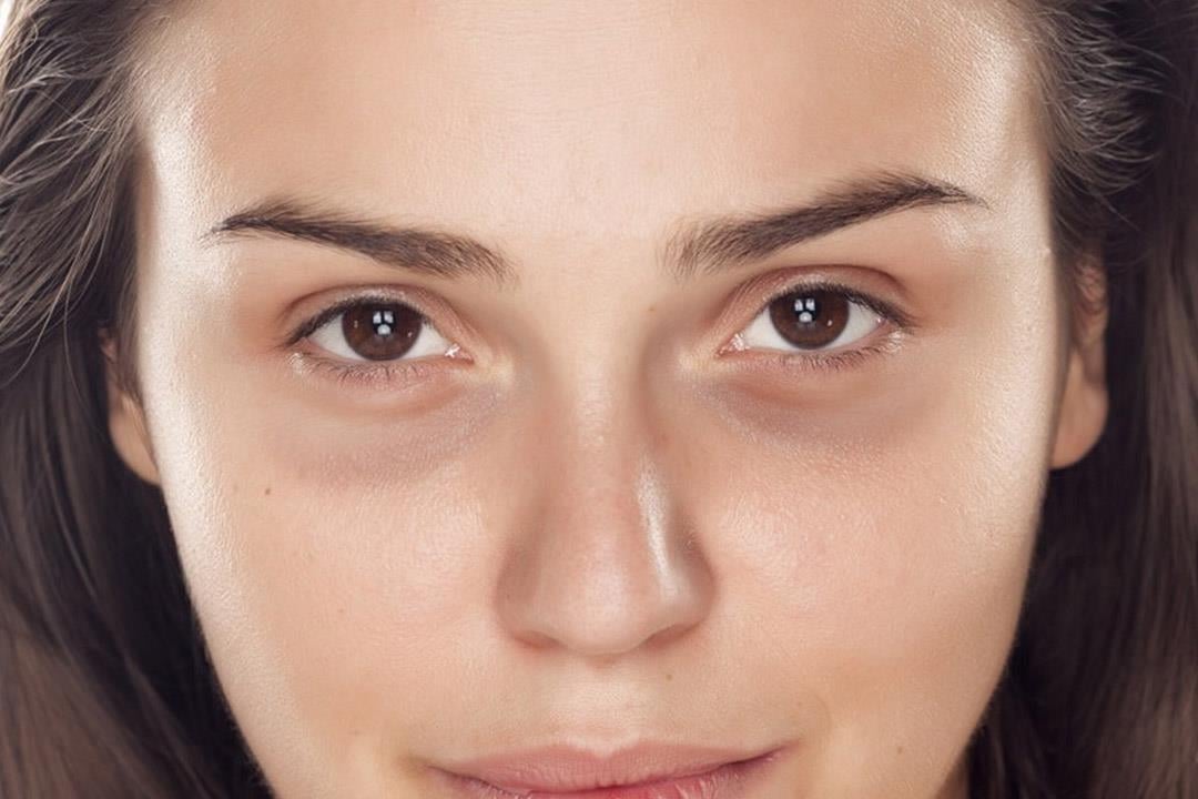 وصفة طبيعية تقضى على الهالات السوداء&nbsp;