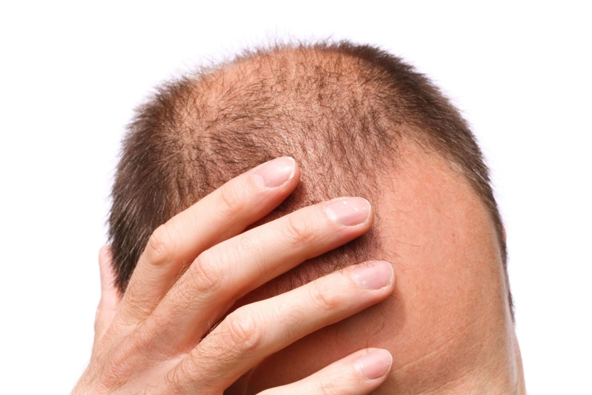 تساقط الشعروعلاجه