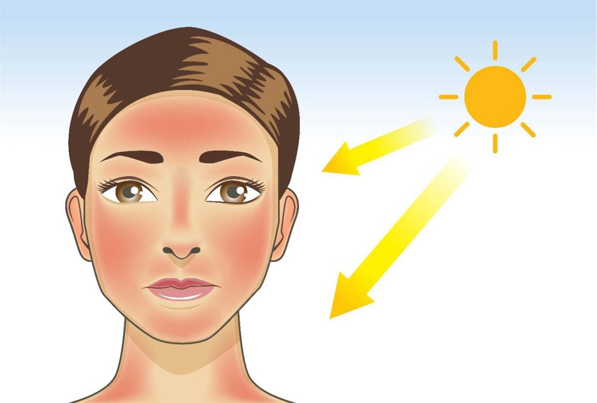 ماسكات لعلاج حروق الشمس