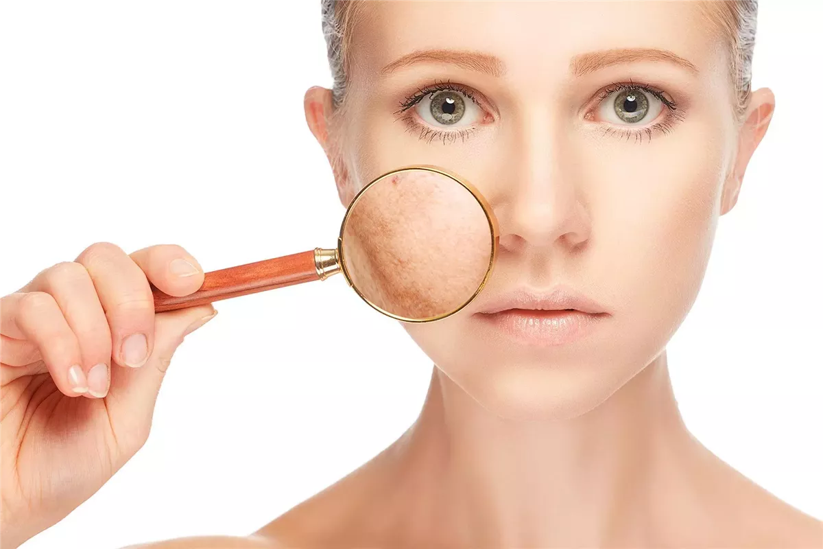 علاج تصبغات الشمس