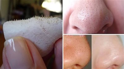 طرق بسيطة تخلصك من البثور البيضاء بالبشرة