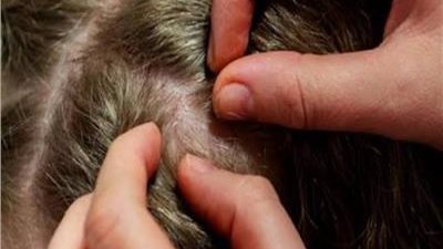 إجراءات وقائية تجنب طفلك عدوى القمل فى المدارس&nbsp;