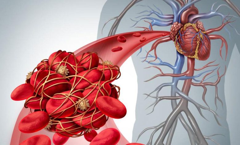 قلة الحركة وقلة شرب الماء سبب رئيسي للجلطات&nbsp;