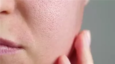 المسام الواسعة بالبشرة&nbsp;