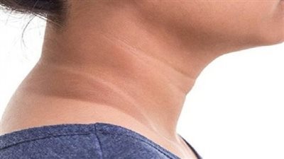 مقاومة الأنسولين&nbsp;