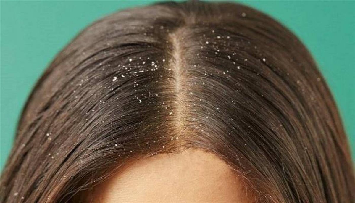 أسباب قشرة الرأس