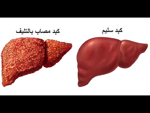 5 علامات صباحية تؤكد الإصابة بتليف الكبد&nbsp;