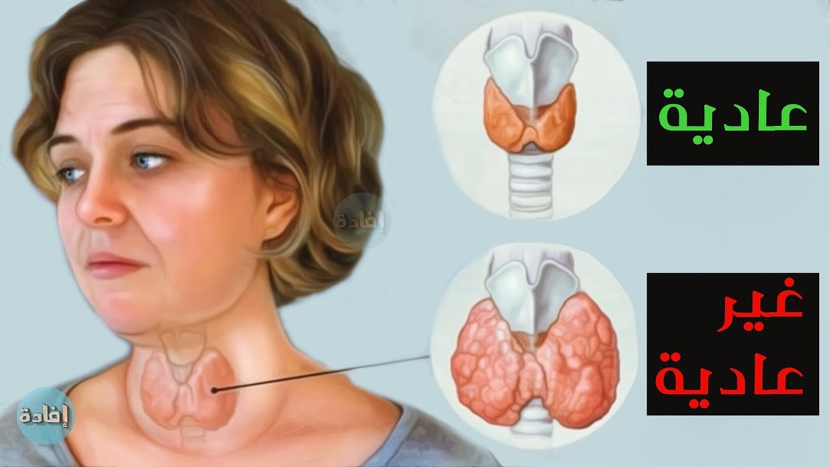 أعراض قصور الغدة الدرقية