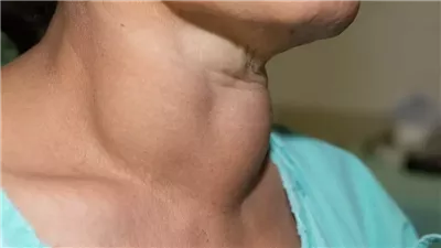 هل الكيتو دايت مناسب لمرضى الغدة الدرقية&nbsp;