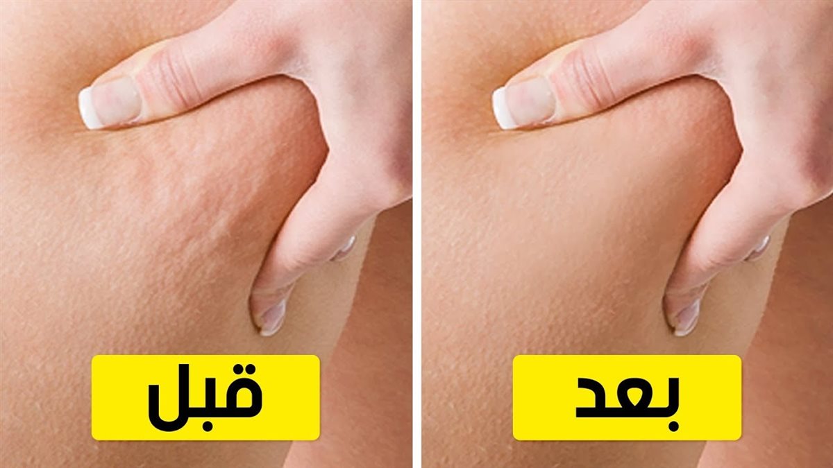 التخلص من السيلوليت
