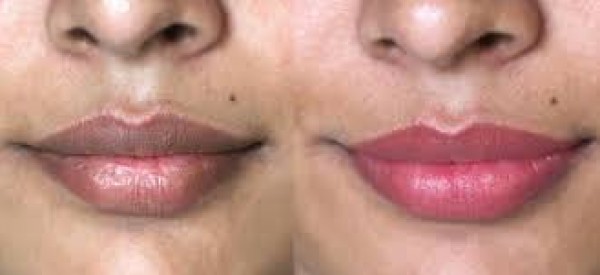 طرق التخلص من الاسمرار حول الفم&nbsp;