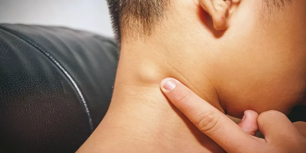 أسباب ظهور كلكوعة فى رقبة الطفل&nbsp;