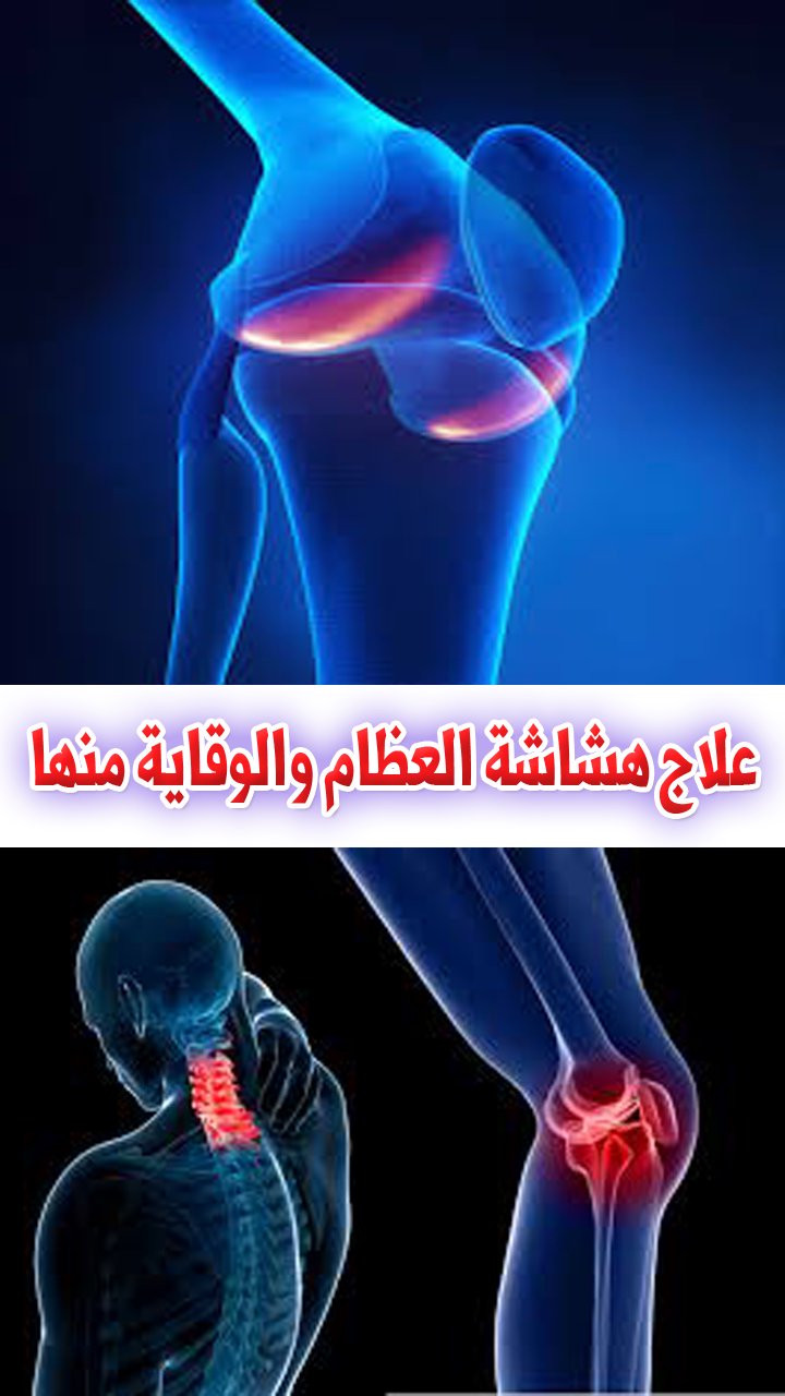 علاج هشاشة العظام