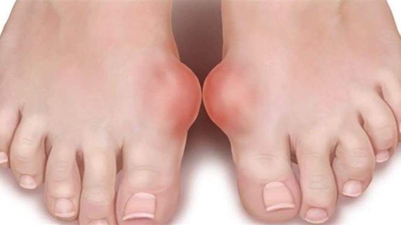 مرض النقرس
