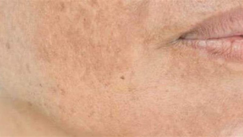  طرق التخلص من تصبغات