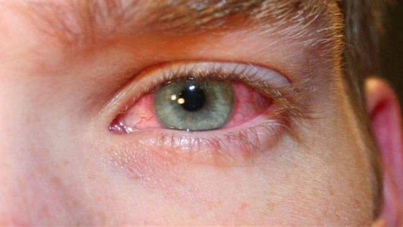 أعراض ارتفاع ضغط