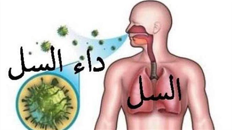 مرض السل