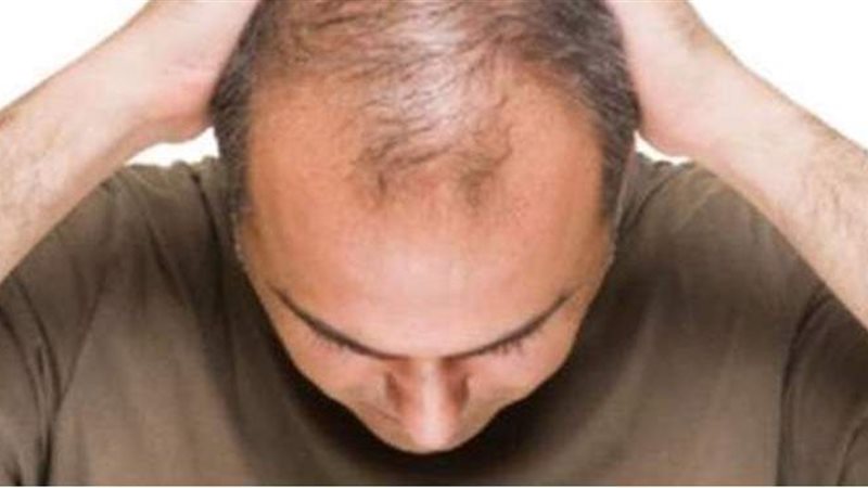 تساقط الشعر عند الرجال