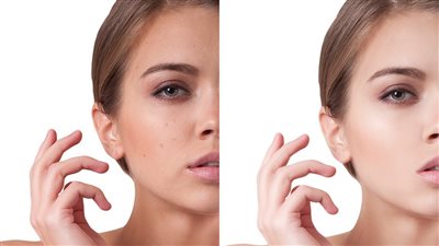 طرق التخلص من المسامات الواسعة نهائيًا 