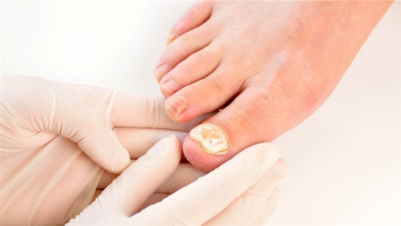 علاج فطريات الاظافر