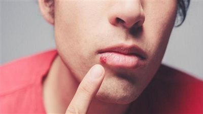 علاج الهربس وأنواعه.. وأسباب الإصابة والأعراض