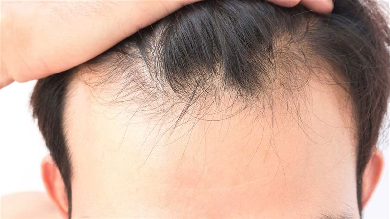 علاج تساقط الشعر