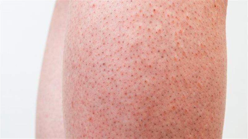 طرق علاج جلد الوزة
