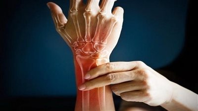 مرض تكلس العظام، طبيب يوضح طرق اكتشاف الإصابة والعلاج 