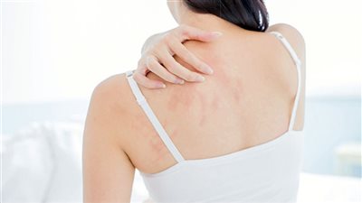 أعراض الملاريا.. وطرق الوقاية والقضاء عليها