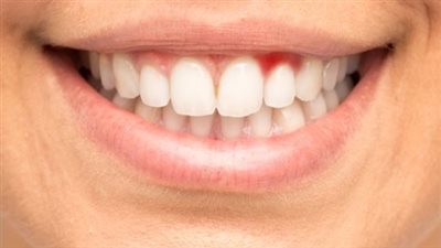 ما هي أعراض وطرق علاج التهاب اللثة؟ 