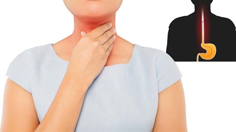 علاج ارتجاع المريء