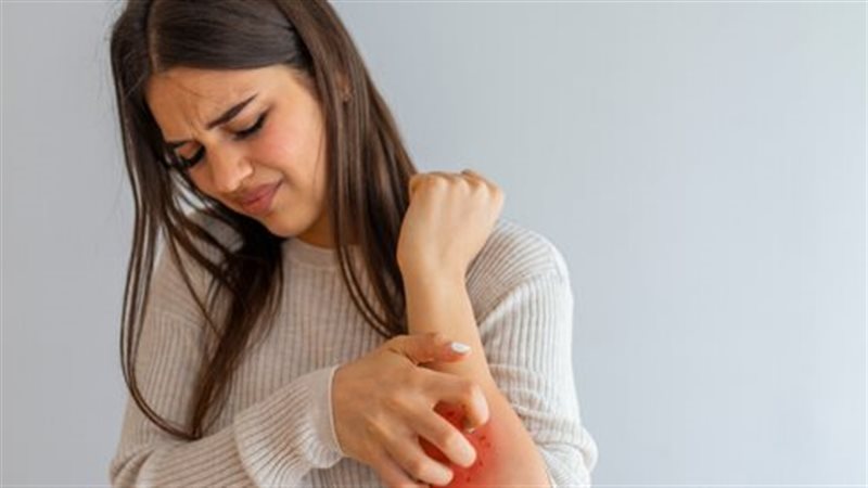 حساسية الجلد، فيتو