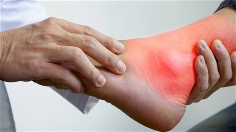علاج النقرس
