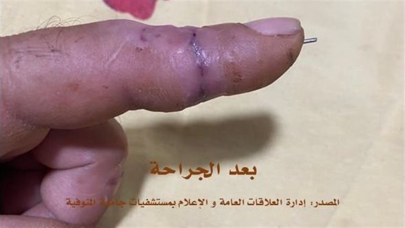 بعد الجراحة