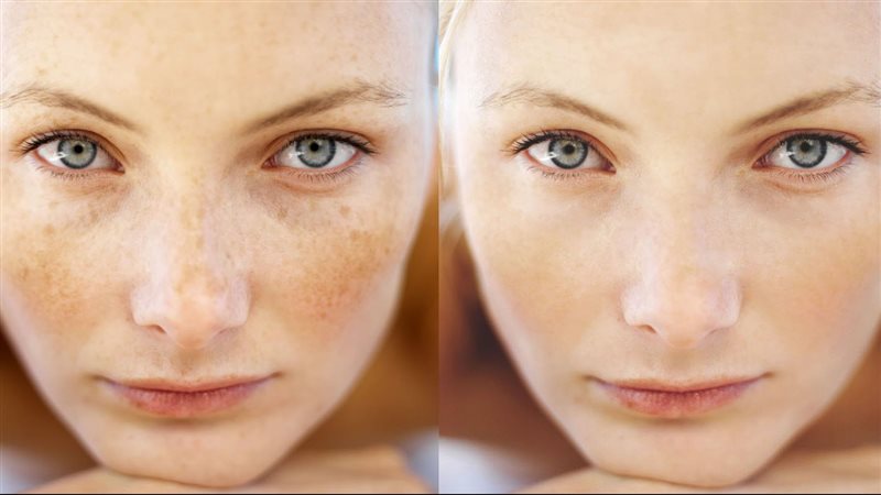 ماسكات لعلاج النمش
