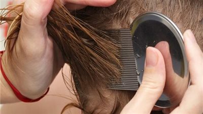  طرق منزلية للتخلص والعلاج من القمل في الشعر