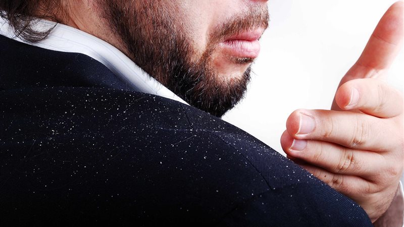 علاج القشرة الدهنية،