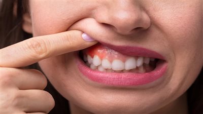 قرحة الفم من أبرز الأعراض، تعرف على أسباب وأعراض سرطان اللثة (فيديو) 