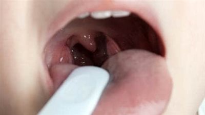 علاج التهاب الحلق بالأعشاب الطبيعية أبرزها الكركم والزنجبيل 