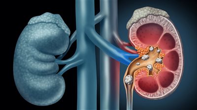 أعراض حصوات الكلى وطرق العلاج بالأعشاب ونصائح للوقاية