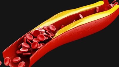 علاج ارتفاع الكوليسترول في أسرع وقت بالخضراوات والفواكه