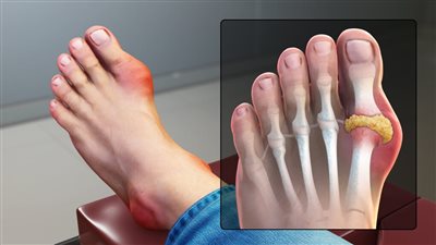  أسباب الإصابة بمرض النقرس وأهم أعراضه