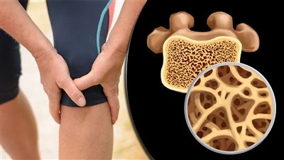 علاج هشاشة العظام، الأعراض وطرق الوقاية