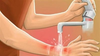 علاج الحروق في المنزل، من مطبخك أبرزها الملح والزبادي